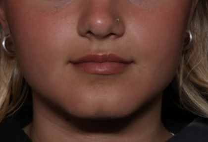 Injectable Fillers Before & After Patient #36166