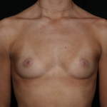 Breast Augmentation Before & After Patient #36185