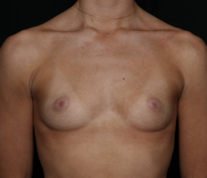 Breast Augmentation Before & After Patient #36185