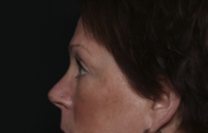 Upper Blepharoplasty Before & After Patient #36036