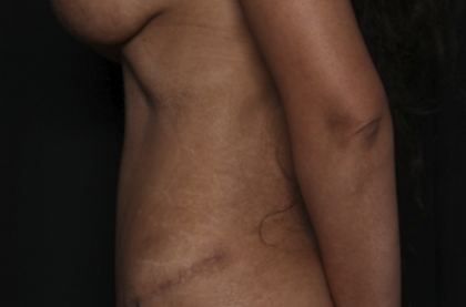 Tummy Tuck Before & After Patient #36047