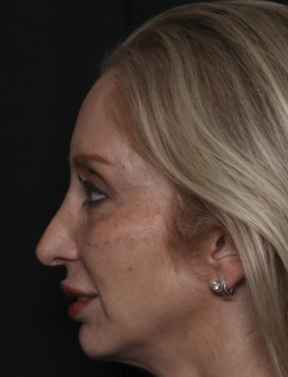 Injectable Fillers Before & After Patient #36124