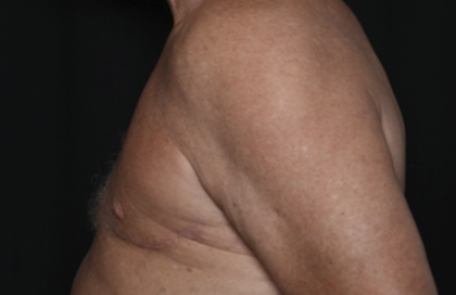 Gynecomastia Before & After Patient #36025