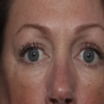 Upper Blepharoplasty Before & After Patient #36036