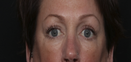 Upper Blepharoplasty Before & After Patient #36036