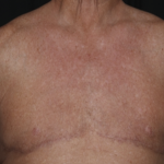 Gynecomastia Before & After Patient #36025