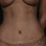 Tummy Tuck Before & After Patient #36047