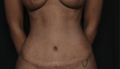 Tummy Tuck Before & After Patient #36047