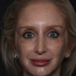 Injectable Fillers Before & After Patient #36124