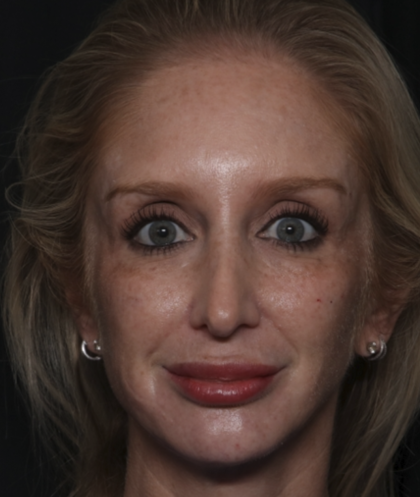 Injectable Fillers Before & After Patient #36124
