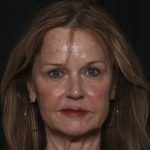Injectable Fillers Before & After Patient #36148