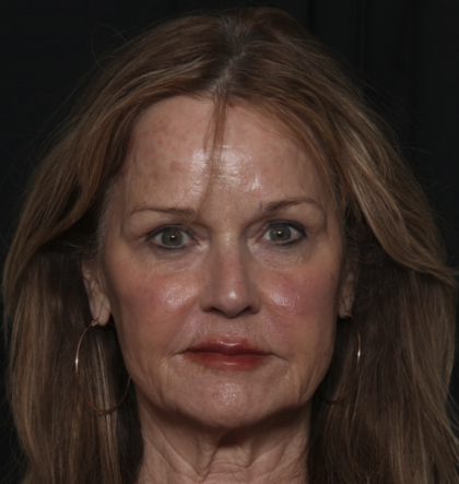 Injectable Fillers Before & After Patient #36148