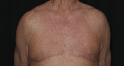 Gynecomastia Before & After Patient #36025