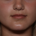 Injectable Fillers Before & After Patient #36166