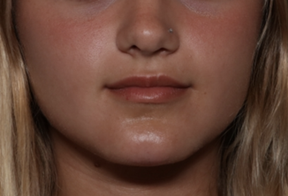 Injectable Fillers Before & After Patient #36166