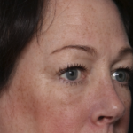 Upper Blepharoplasty Before & After Patient #36036