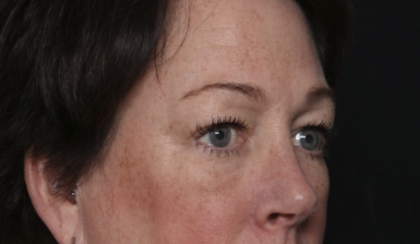 Upper Blepharoplasty Before & After Patient #36036