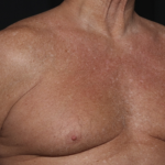 Gynecomastia Before & After Patient #36025