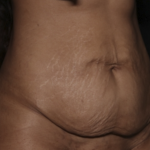Tummy Tuck Before & After Patient #36047