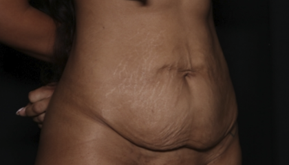 Tummy Tuck Before & After Patient #36047