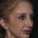 Injectable Fillers Before & After Patient #36124