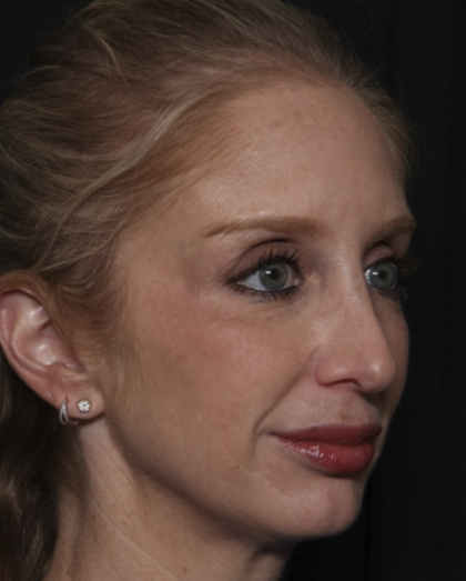 Injectable Fillers Before & After Patient #36124