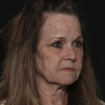 Injectable Fillers Before & After Patient #36148
