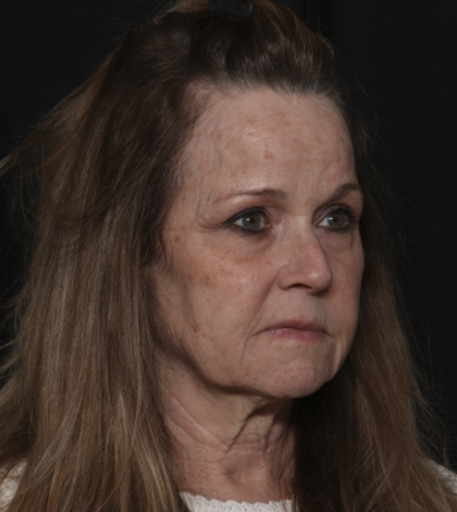 Injectable Fillers Before & After Patient #36148