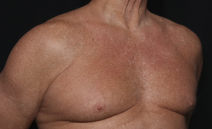 Gynecomastia Before & After Patient #36025