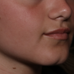 Injectable Fillers Before & After Patient #36166