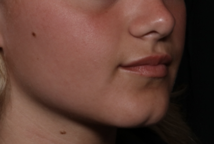 Injectable Fillers Before & After Patient #36166
