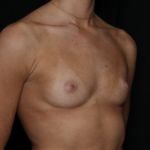 Breast Augmentation Before & After Patient #36185