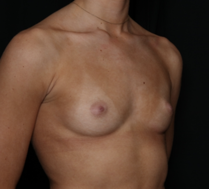 Breast Augmentation Before & After Patient #36185