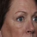 Upper Blepharoplasty Before & After Patient #36036