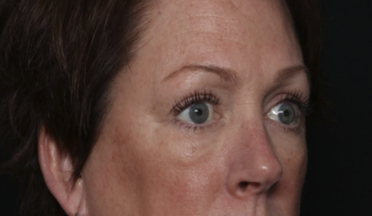 Upper Blepharoplasty Before & After Patient #36036
