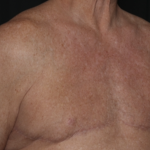 Gynecomastia Before & After Patient #36025