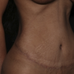 Tummy Tuck Before & After Patient #36047