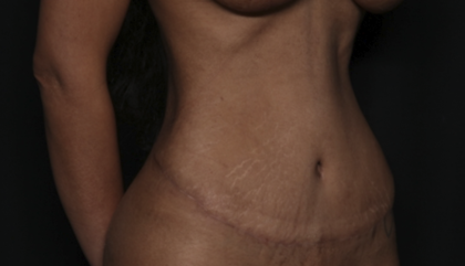 Tummy Tuck Before & After Patient #36047