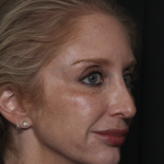 Injectable Fillers Before & After Patient #36124