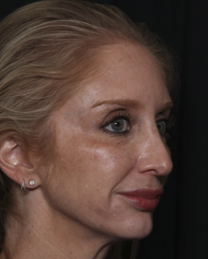 Injectable Fillers Before & After Patient #36124