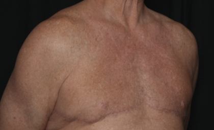 Gynecomastia Before & After Patient #36025