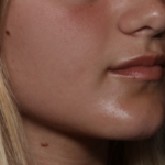 Injectable Fillers Before & After Patient #36166