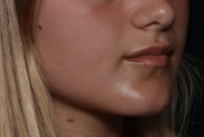 Injectable Fillers Before & After Patient #36166