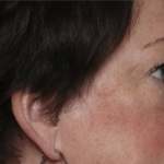 Upper Blepharoplasty Before & After Patient #36036