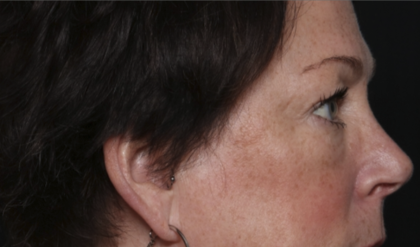 Upper Blepharoplasty Before & After Patient #36036