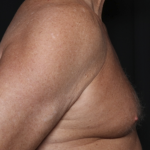 Gynecomastia Before & After Patient #36025