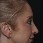 Injectable Fillers Before & After Patient #36124