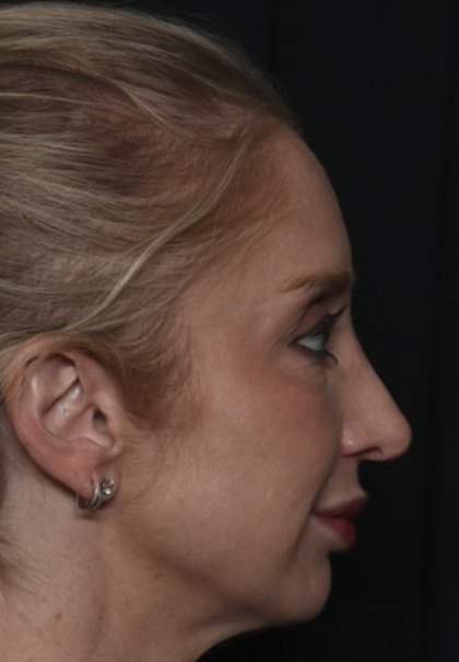 Injectable Fillers Before & After Patient #36124