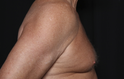 Gynecomastia Before & After Patient #36025