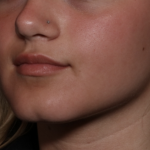Injectable Fillers Before & After Patient #36166